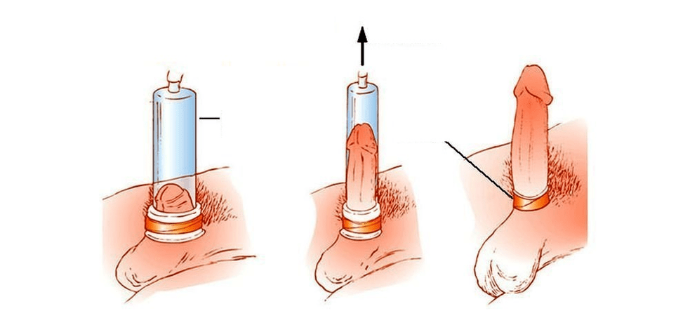 how a vacuum pump for penis enlargement works