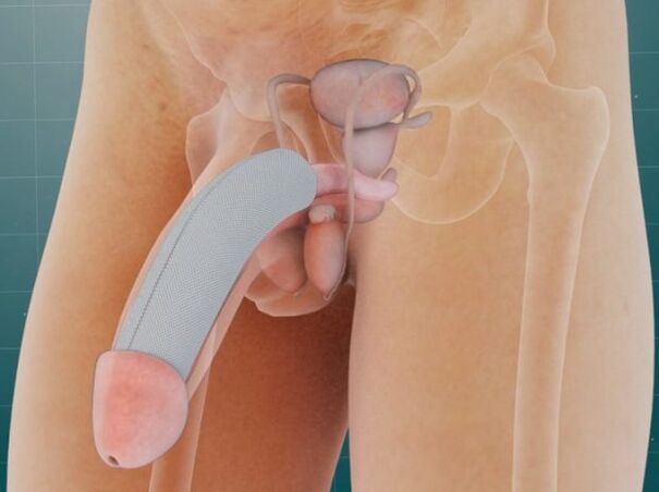 The penis after the introduction of a special implant under the skin