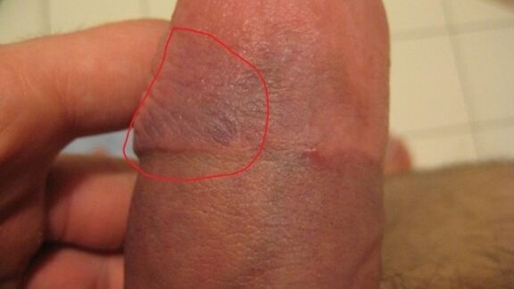 bruise on the penis after a vacuum pump