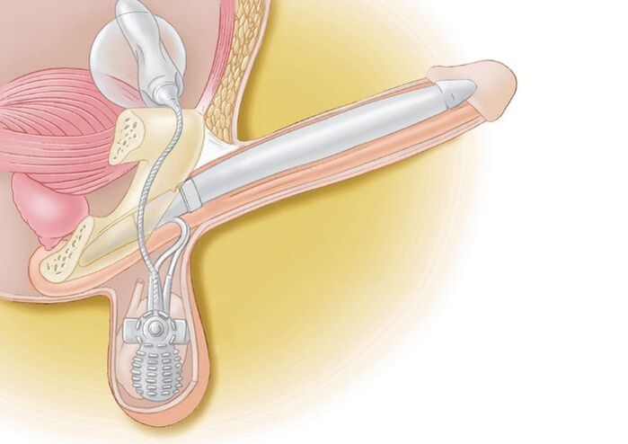 penile prosthesis for enlargement